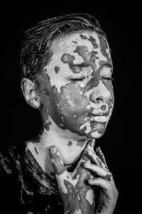 デリケートゾーンの色素沈着を改善するためのクリームは何が効果的？