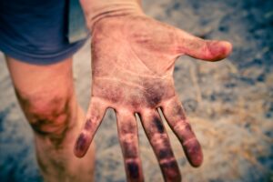 敏感肌の人がVIOの黒ずみをトレチノインで使用する際の注意点は？